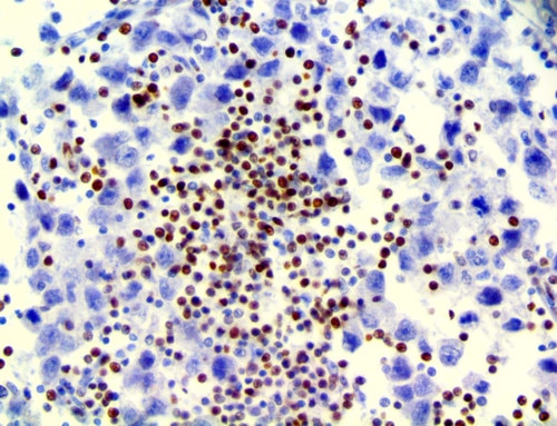 LEF-1 Antibody Immunohistochemistry on a FFPE Testicular Carcinoma Tissue